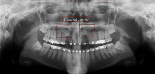 impacted teeth xray